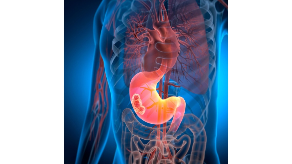 from pancreatic cancer to a new digestive system: the survival