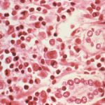 hantavirus outbreak on mv hondius cruise ship leaves three dead,