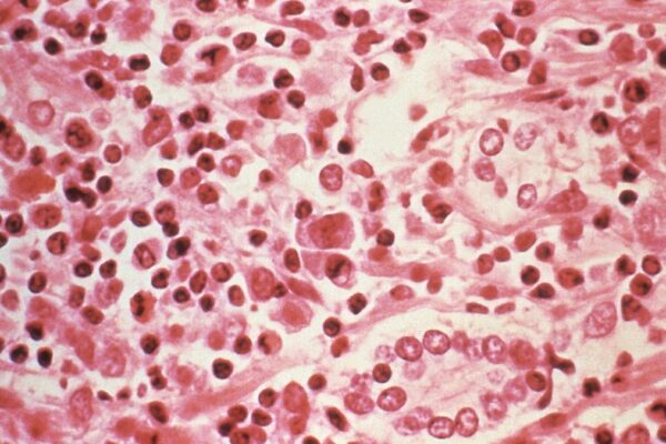hantavirus outbreak on mv hondius cruise ship leaves three dead,