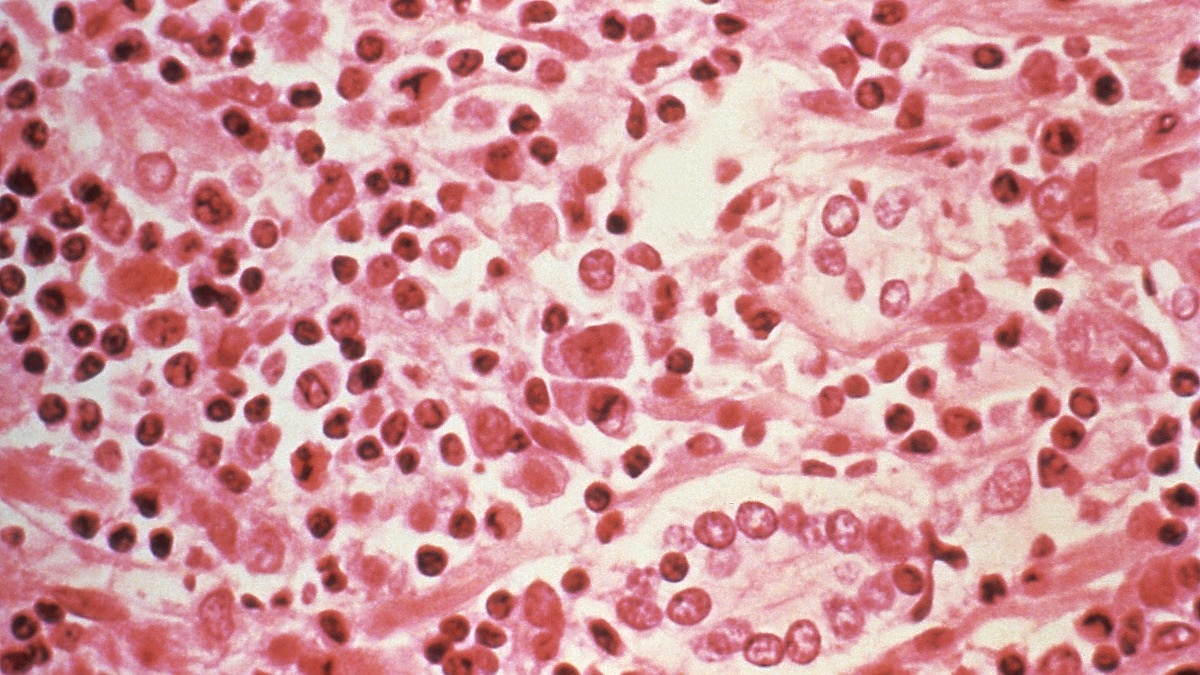 hantavirus outbreak on mv hondius cruise ship leaves three dead,